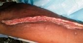Graphical Abstract of Saphenous vein harvest wound complications: risk factors, identification, prevention, and management